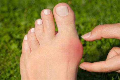 Balmumu ile ayak parmaklarının osteoartriti nasıl tedavi edilir